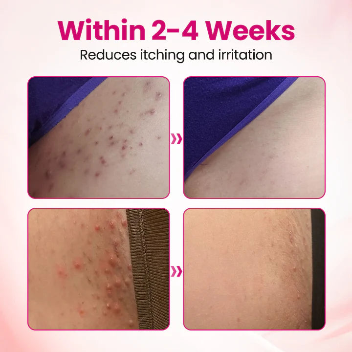 HPV negative conversion power MAX! 🌸LOVILDS™ interferon gel: Targeting high-risk viruses and repairing the cervix in one step