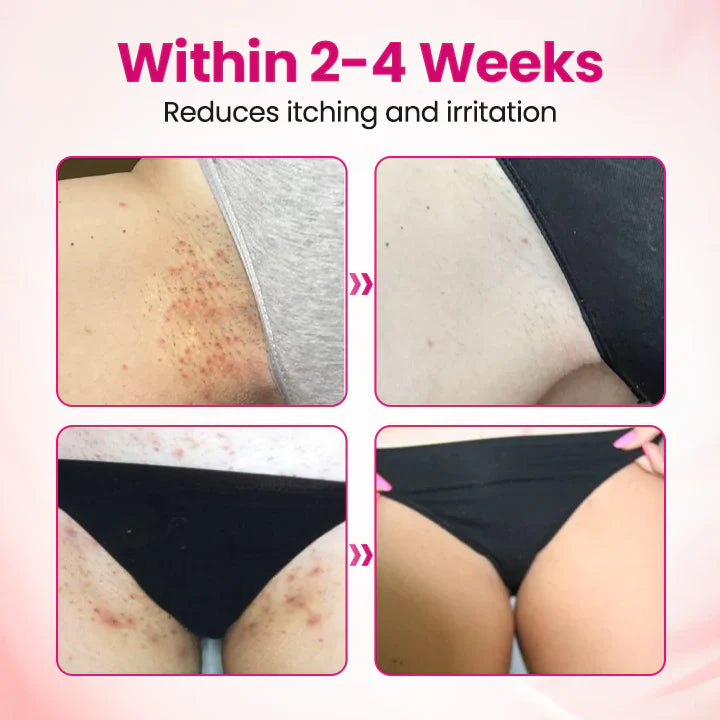 HPV negative conversion power MAX! 🌸LOVILDS™ interferon gel: Targeting high-risk viruses and repairing the cervix in one step
