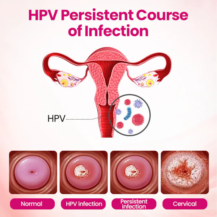 HPV negative conversion power MAX! 🌸LOVILDS™ interferon gel: Targeting high-risk viruses and repairing the cervix in one step