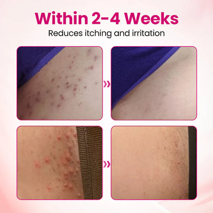 HPV negative conversion power MAX! 🌸LOVILDS™ interferon gel: Targeting high-risk viruses and repairing the cervix in one step