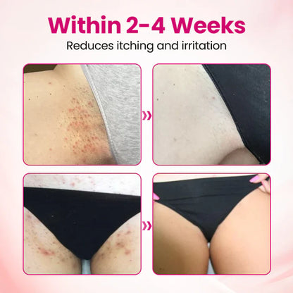 HPV negative conversion power MAX! 🌸LOVILDS™ interferon gel: Targeting high-risk viruses and repairing the cervix in one step